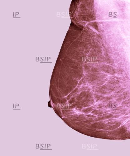 Breast cancer screening, X-ray