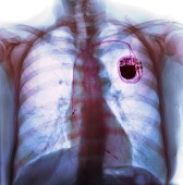 Dual chamber pacemaker, X-ray